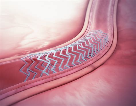  Lactide: Bioresorbowalne materiały medyczne przyszłości?